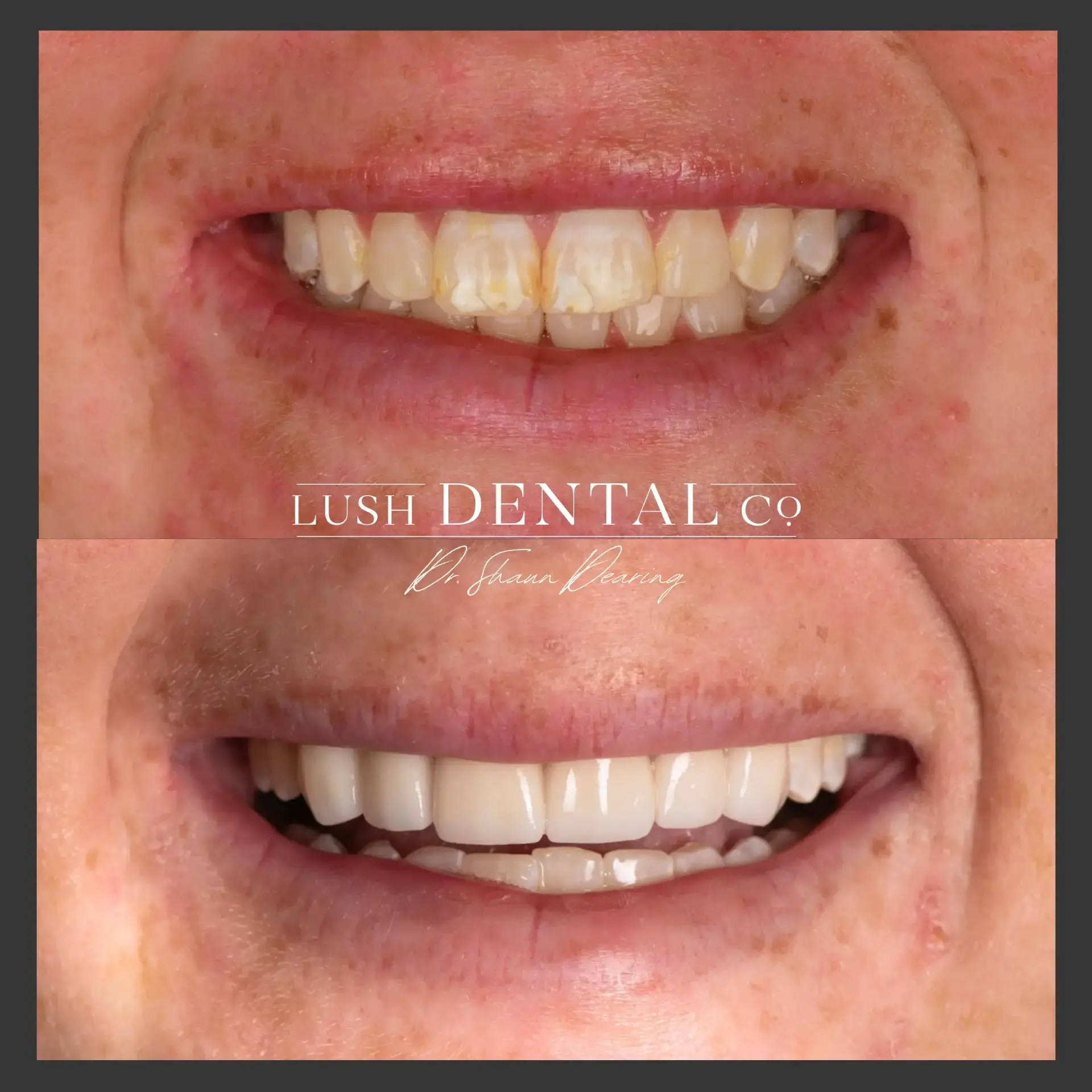 Lush Dental Co. veneers result — Highland, UT