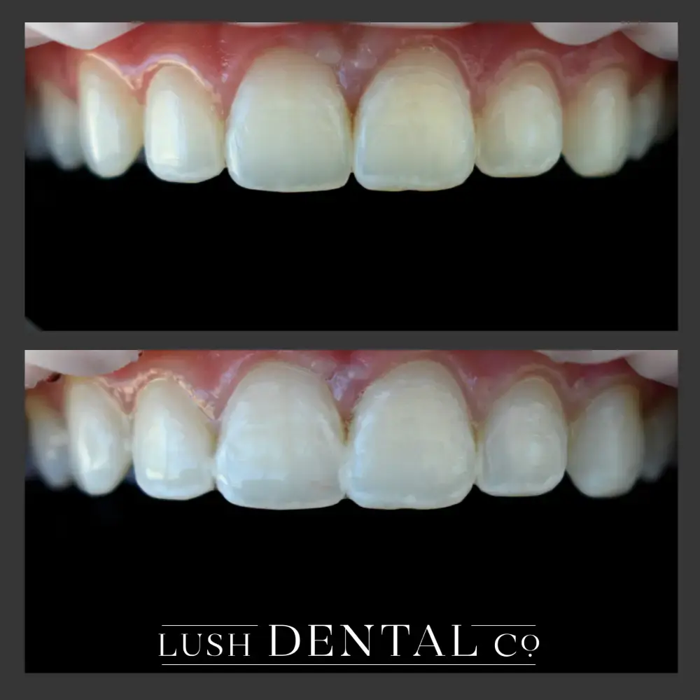 Lush Dental Co. veneers result — Highland, UT