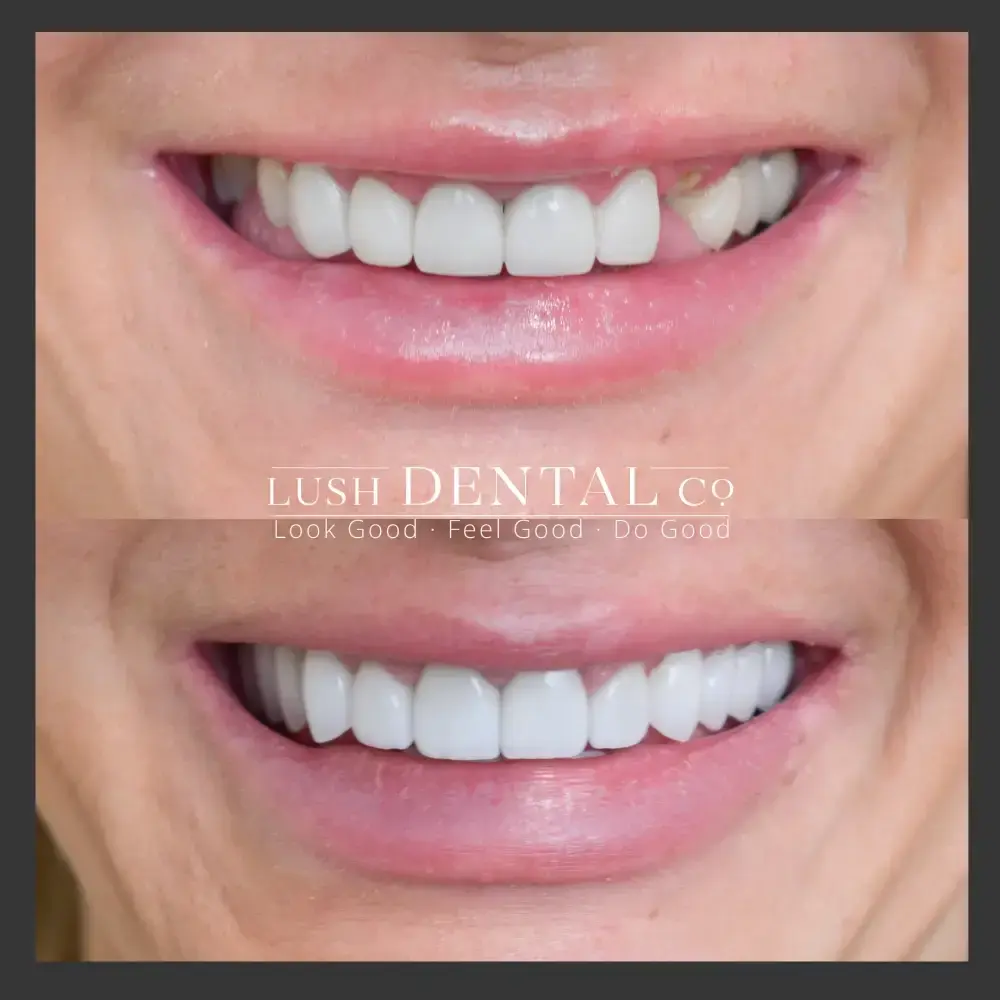 Lush Dental Co. smile makeover result — Highland, UT