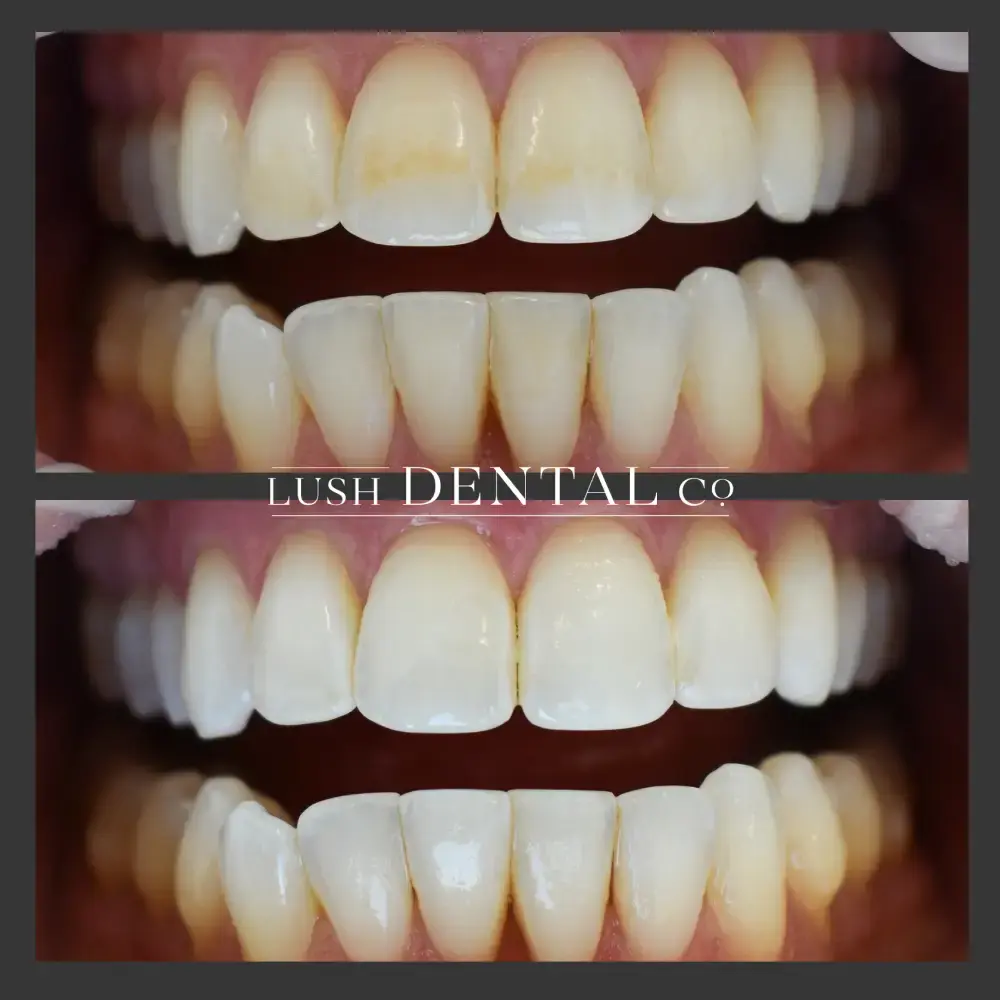 Lush Dental Co. veneers result — Highland, UT
