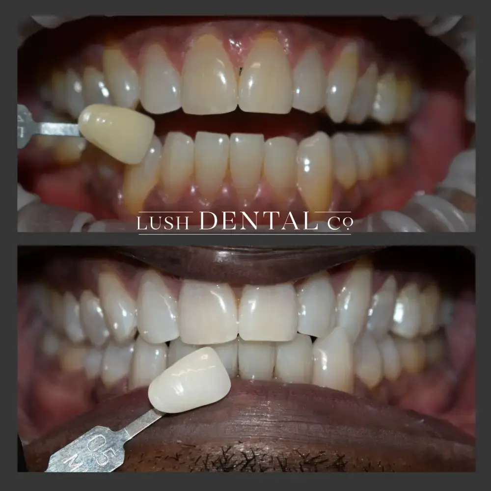 Lush Dental Co. veneers result — Highland, UT