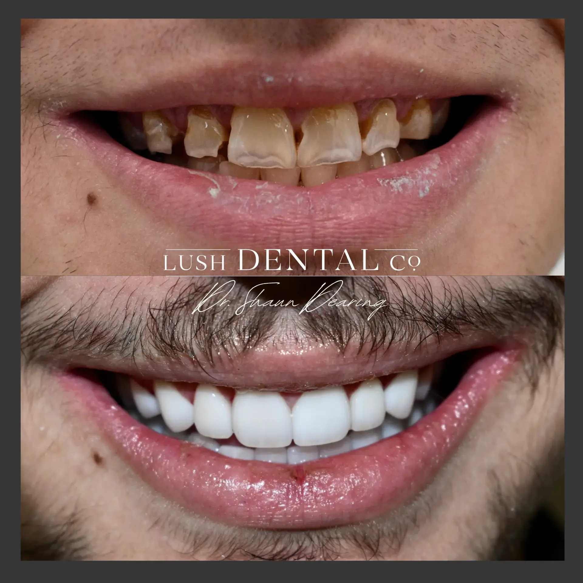 Lush Dental Co. smile makeover result — Highland, UT