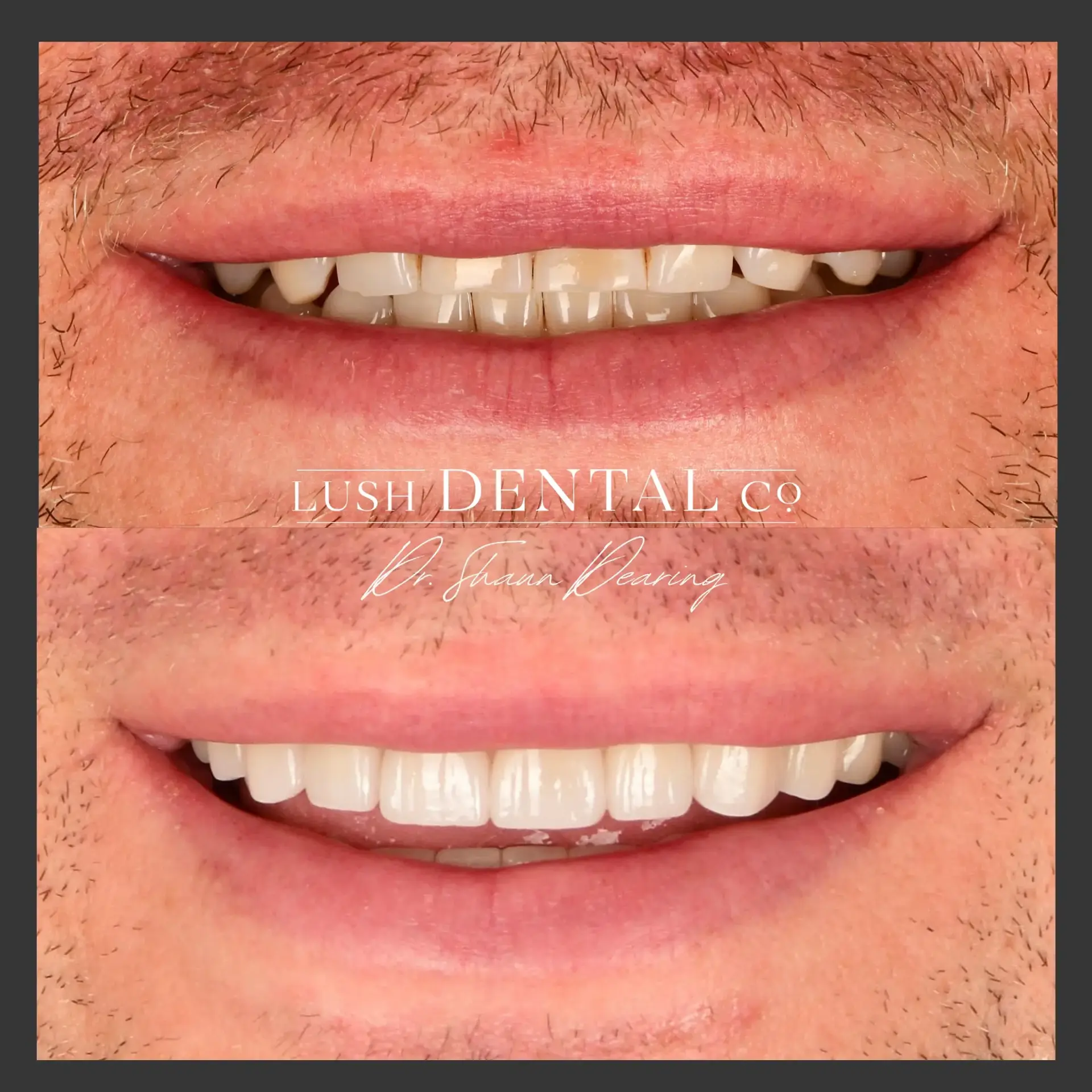 Lush Dental Co. veneers result — Highland, UT