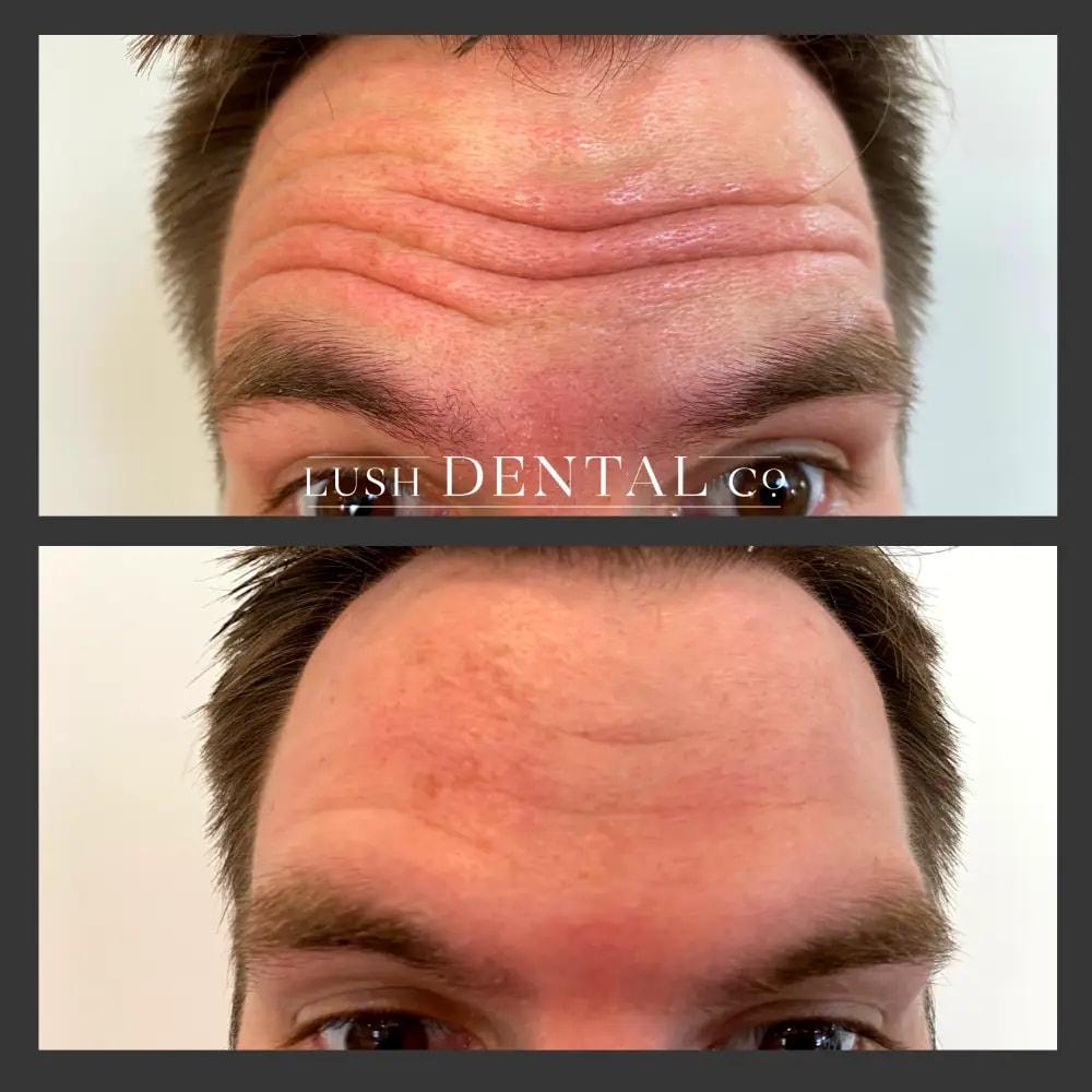 Lush Dental Co. botox result — Highland, UT