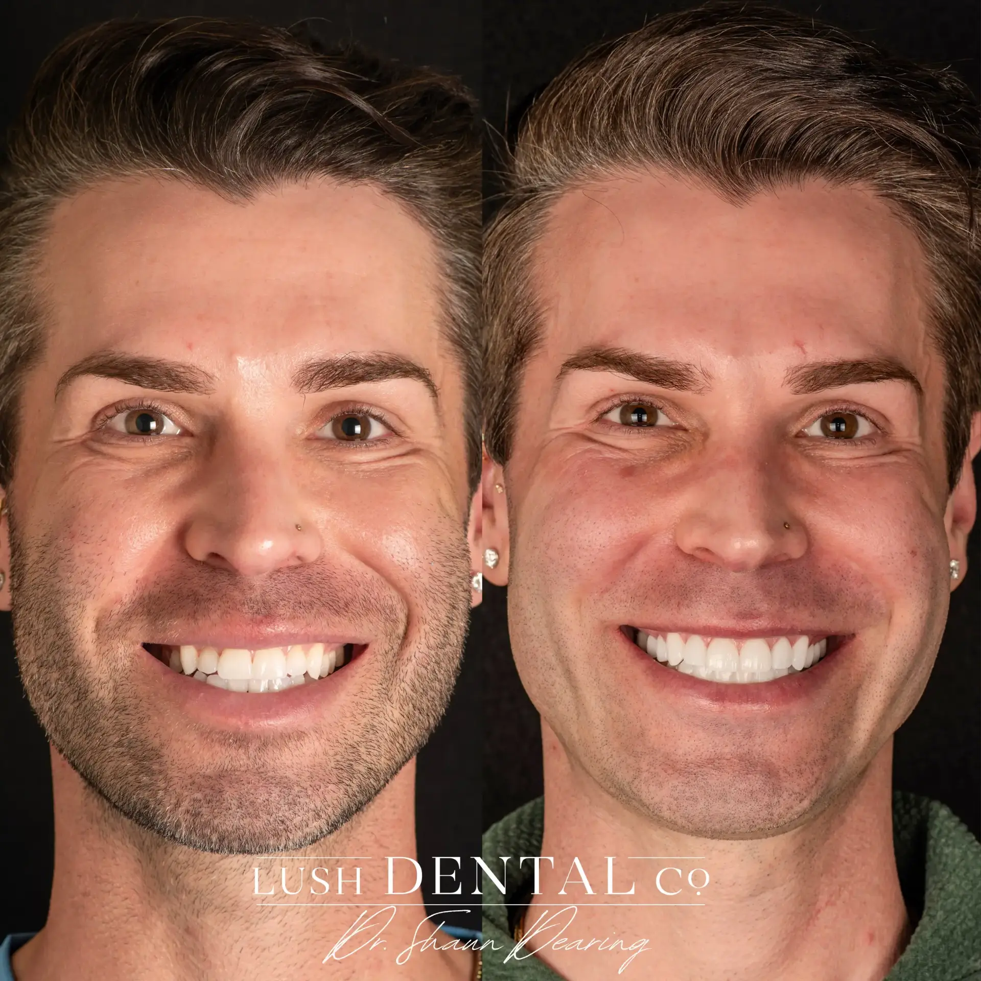 Lush Dental Co. veneers result — Highland, UT