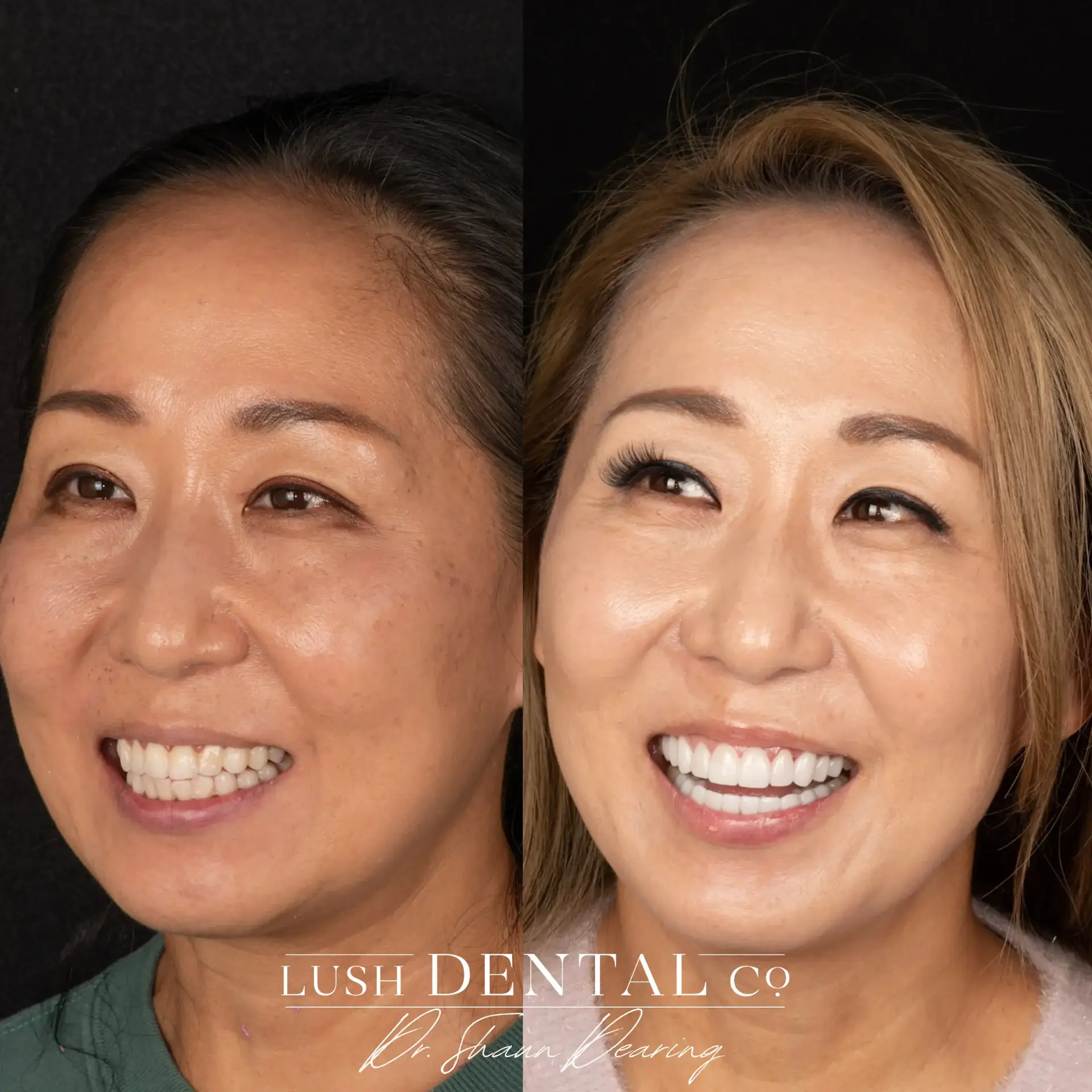 Lush Dental Co. veneers result — Highland, UT