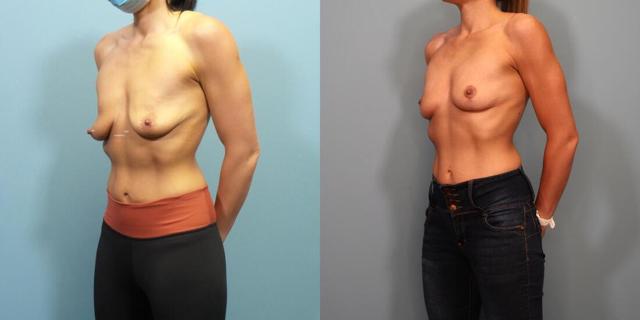 Breast Lift result at Austin Hayes, MD in Portland, OR