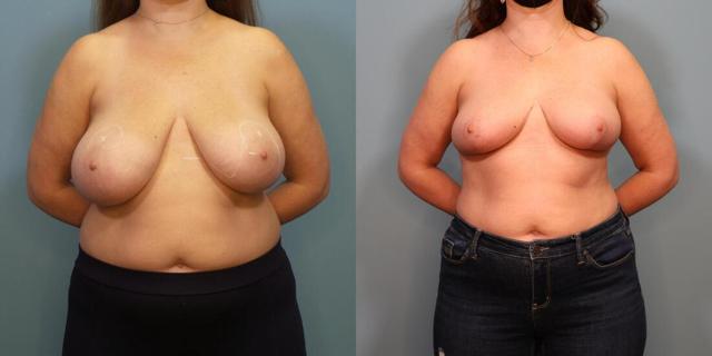 Breast Reduction result at Austin Hayes, MD in Portland, OR