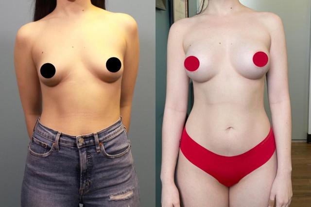 Breast Augmentation result at Austin Hayes, MD in Portland, OR