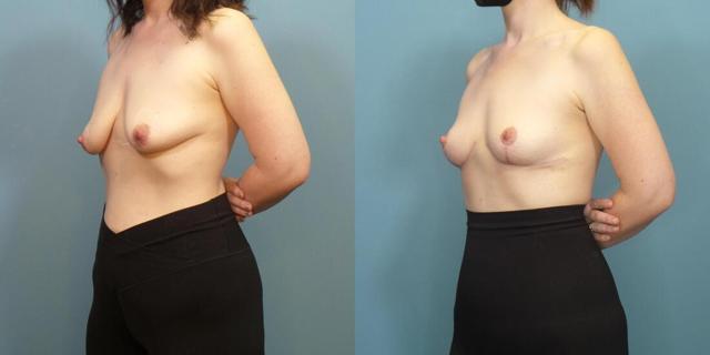 Breast Lift result at Austin Hayes, MD in Portland, OR