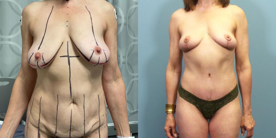Austin Hayes, MD mommy makeover result — Portland, OR