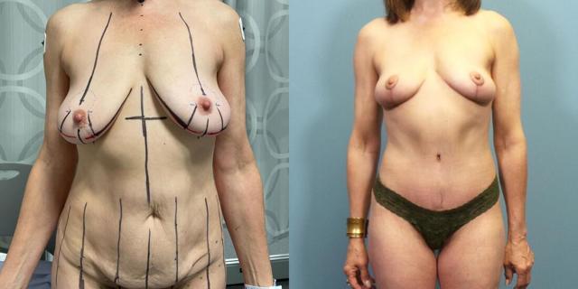 Mommy Makeover result at Austin Hayes, MD in Portland, OR