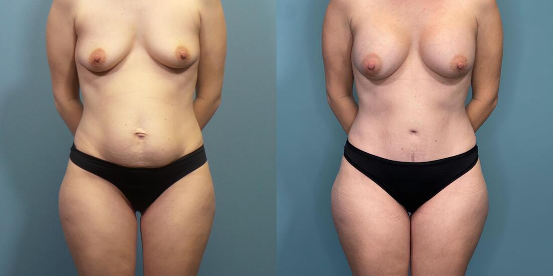 Austin Hayes, MD tummy tuck result — Portland, OR