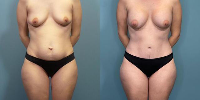Tummy Tuck result at Austin Hayes, MD in Portland, OR