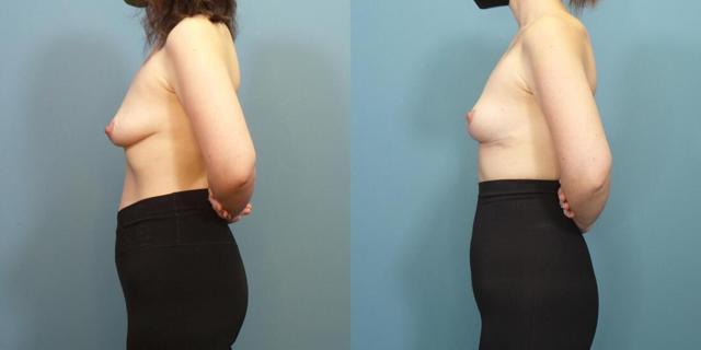 Breast Lift result at Austin Hayes, MD in Portland, OR