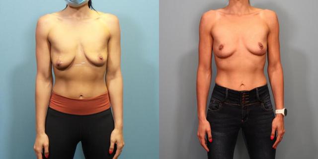 Breast Lift result at Austin Hayes, MD in Portland, OR