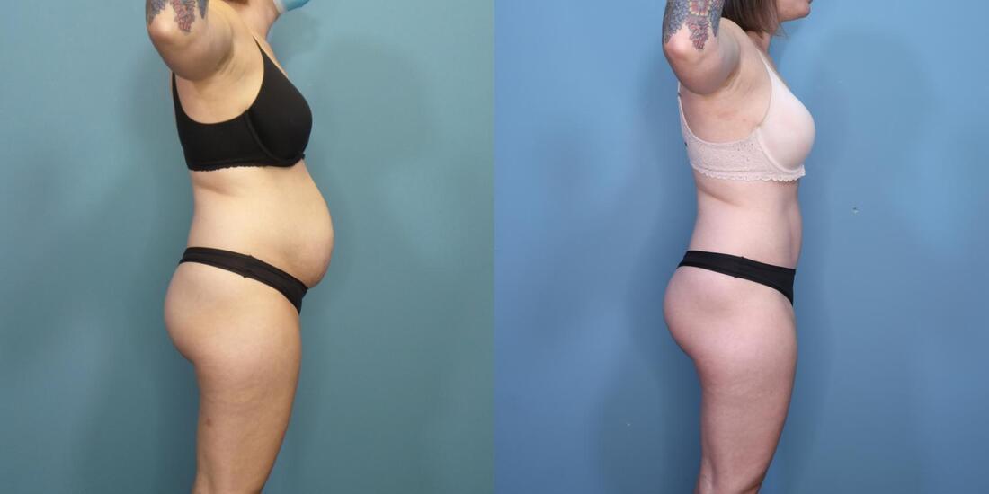 Austin Hayes, MD tummy tuck result — Portland, OR