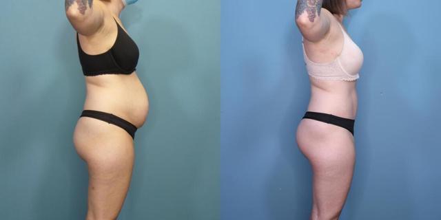 Tummy Tuck result at Austin Hayes, MD in Portland, OR