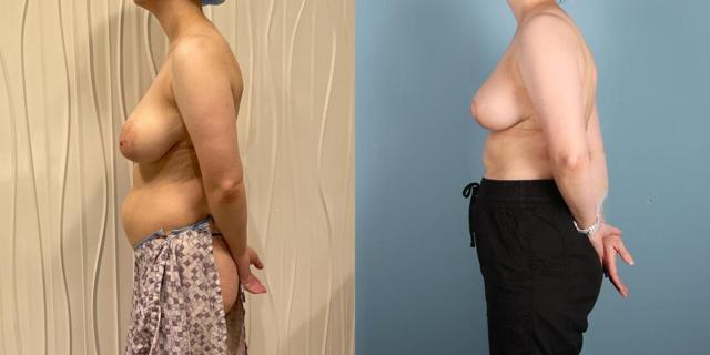 Breast Reduction result at Austin Hayes, MD in Portland, OR
