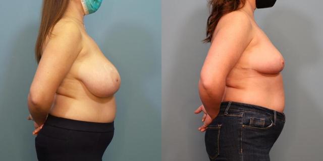 Breast Reduction result at Austin Hayes, MD in Portland, OR
