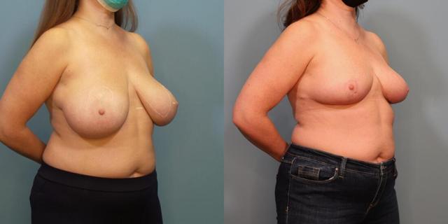 Breast Reduction result at Austin Hayes, MD in Portland, OR