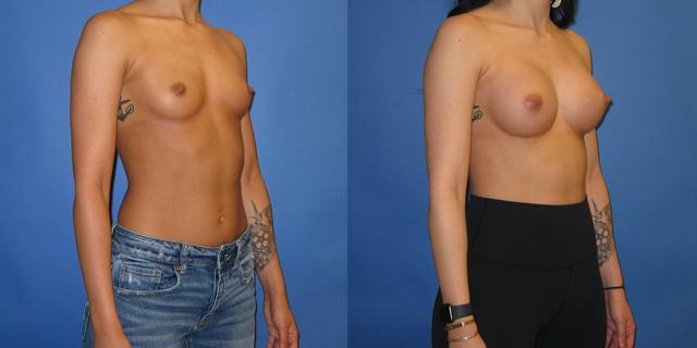 Fat Transfer Breast Augmentation result at Austin Hayes, MD in Portland, OR
