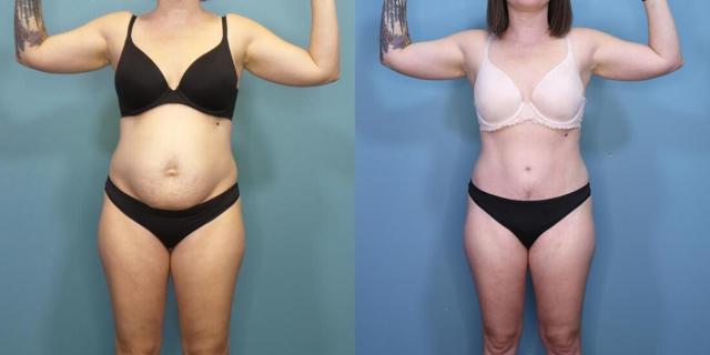 Tummy Tuck result at Austin Hayes, MD in Portland, OR