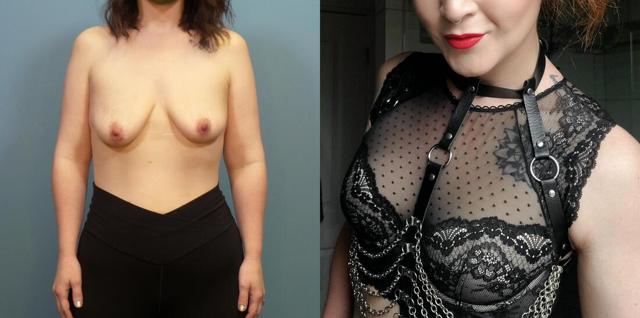 Breast Lift result at Austin Hayes, MD in Portland, OR