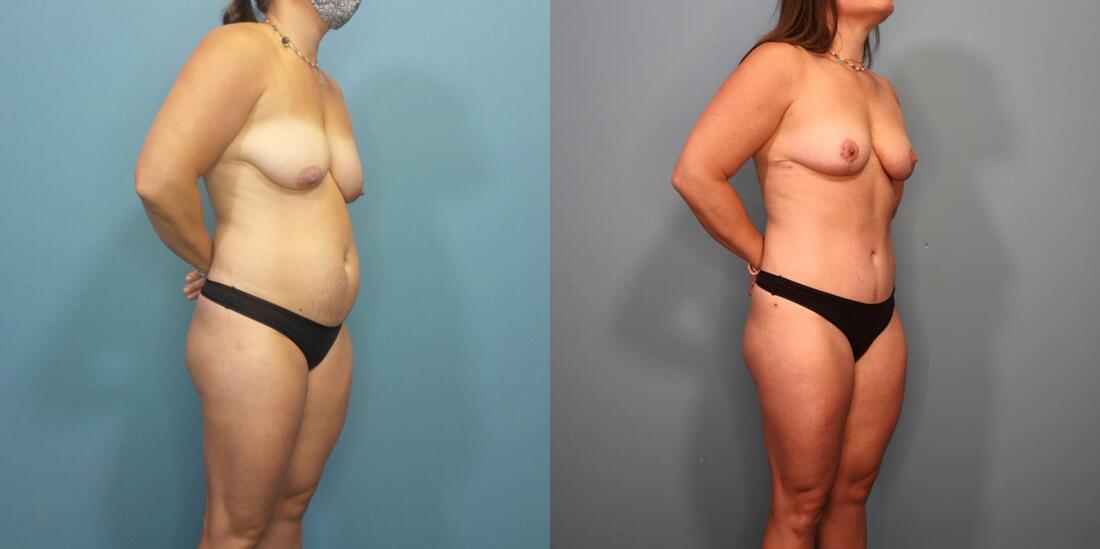 Austin Hayes, MD mommy makeover result — Portland, OR