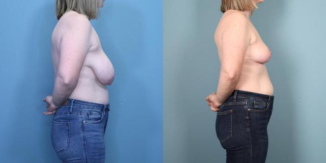 Breast Reduction result at Austin Hayes, MD in Portland, OR