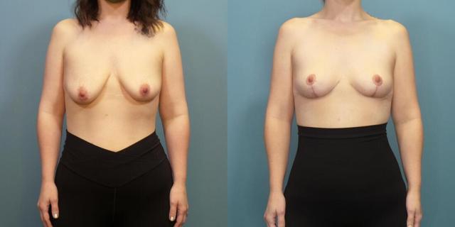 Breast Lift result at Austin Hayes, MD in Portland, OR