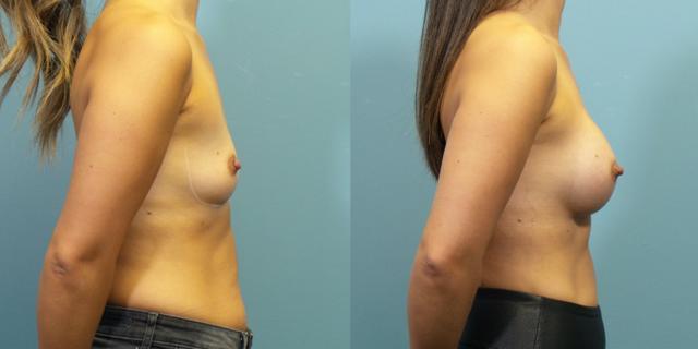 Breast Augmentation result at Austin Hayes, MD in Portland, OR