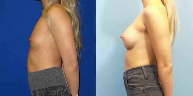 Fat Transfer Breast Augmentation result at Austin Hayes, MD in Portland, OR
