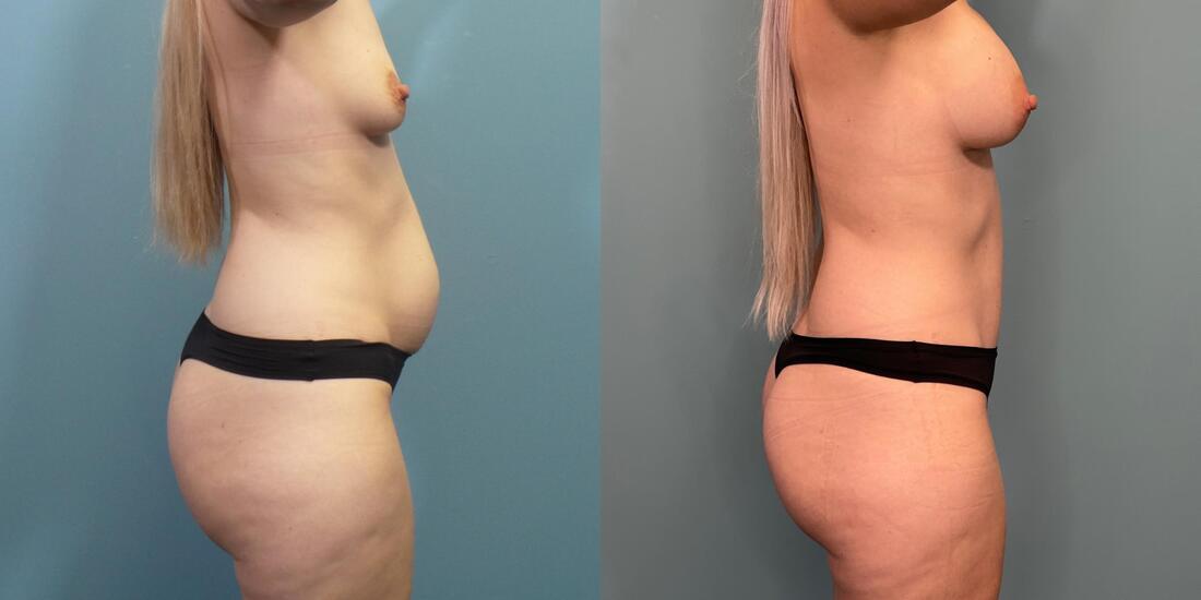 Austin Hayes, MD tummy tuck result — Portland, OR