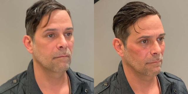Juvederm result at Gallery of Aesthetics in South Jordan, UT