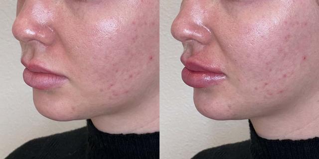 Lip Filler result at Gallery of Aesthetics in South Jordan, UT