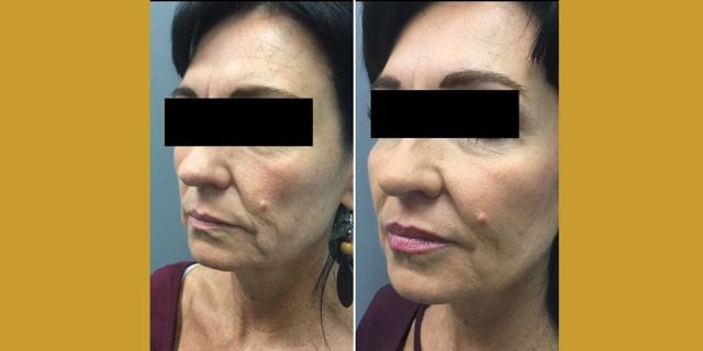 Dermal Fillers result at Gallery of Aesthetics in South Jordan, UT