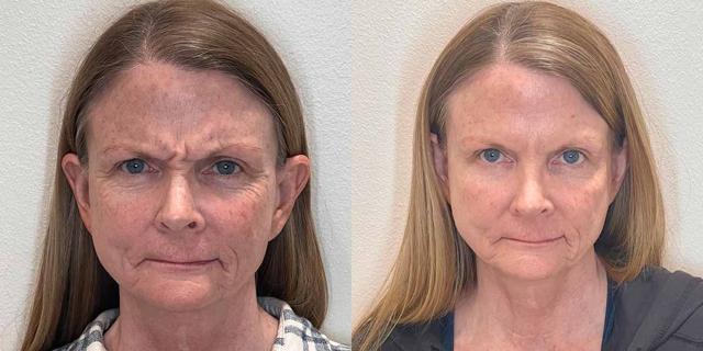 Botox result at Gallery of Aesthetics in South Jordan, UT