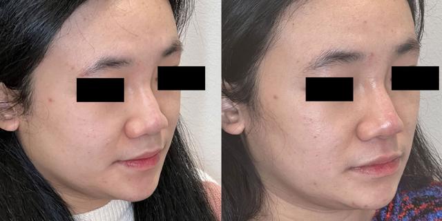 Jawline Filler result at Gallery of Aesthetics in South Jordan, UT