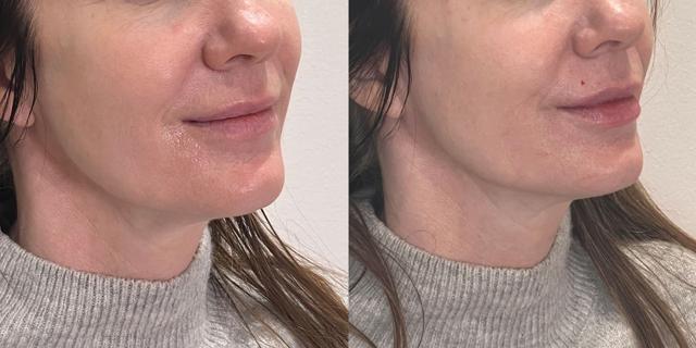 Lip Filler result at Gallery of Aesthetics in South Jordan, UT