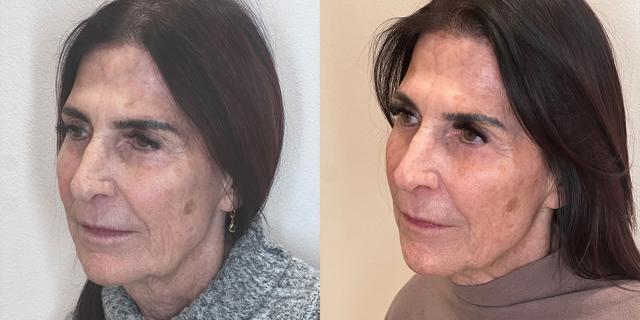 Dermal Fillers result at Gallery of Aesthetics in South Jordan, UT