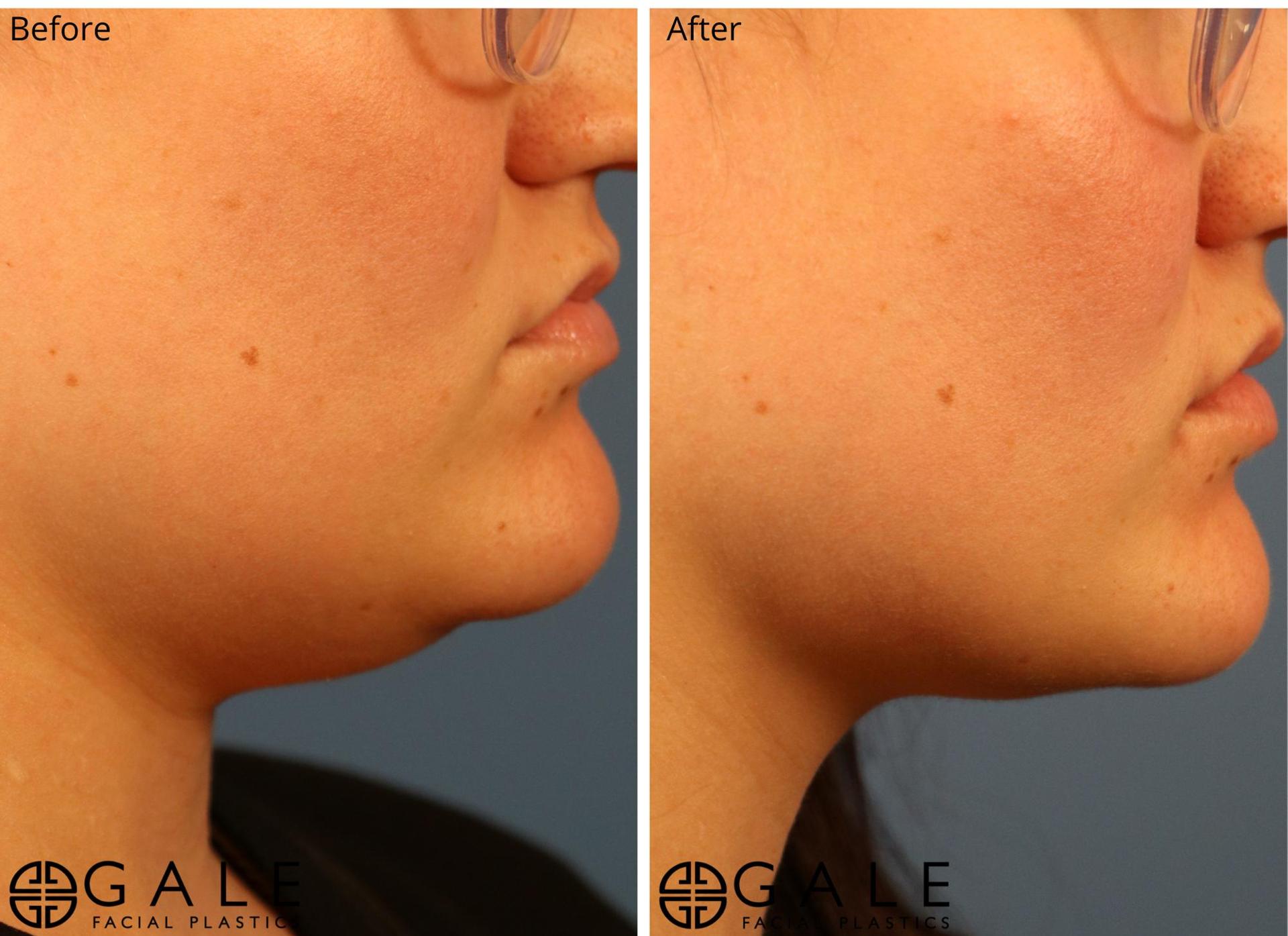 Gale Facial Plastics liposuction result — Riverton, UT