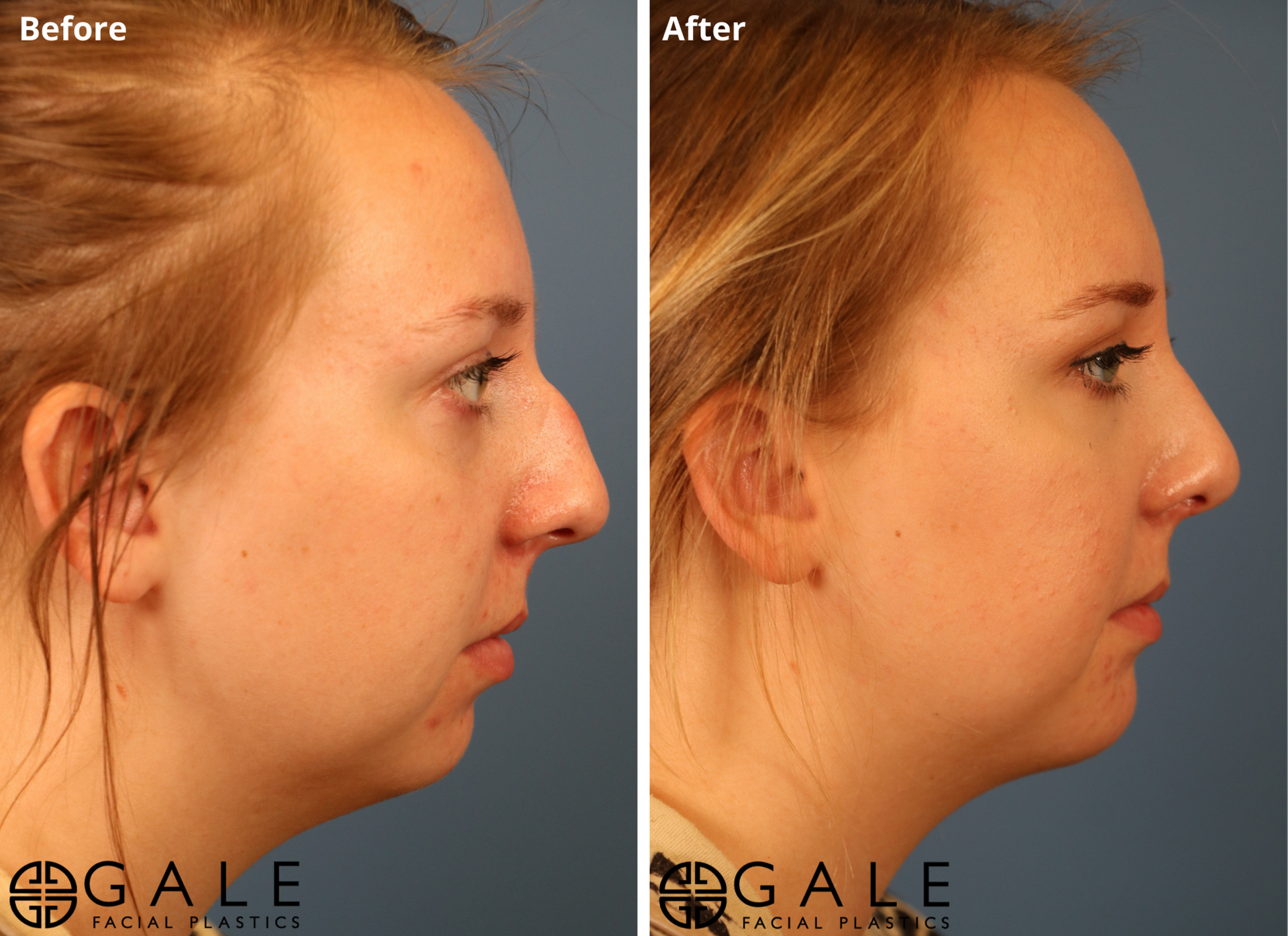 Gale Facial Plastics rhinoplasty result — Riverton, UT