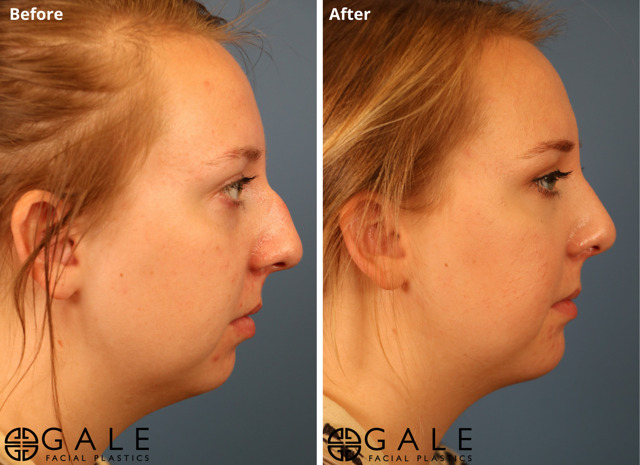 Rhinoplasty result at Gale Facial Plastics in Riverton, UT