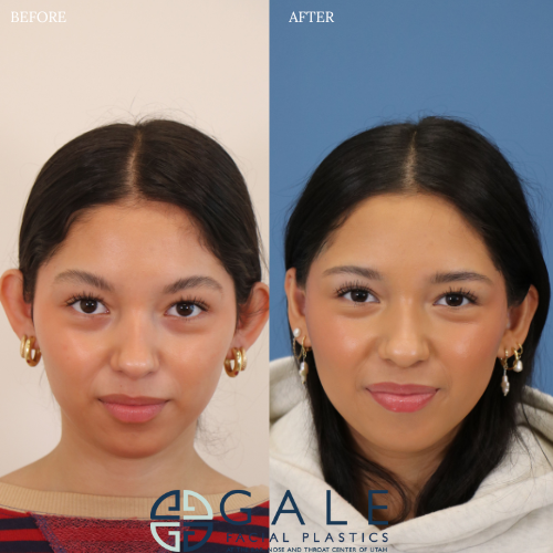Gale Facial Plastics result — Riverton, UT