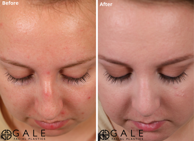 Laser Skin Resurfacing result at Gale Facial Plastics in Riverton, UT