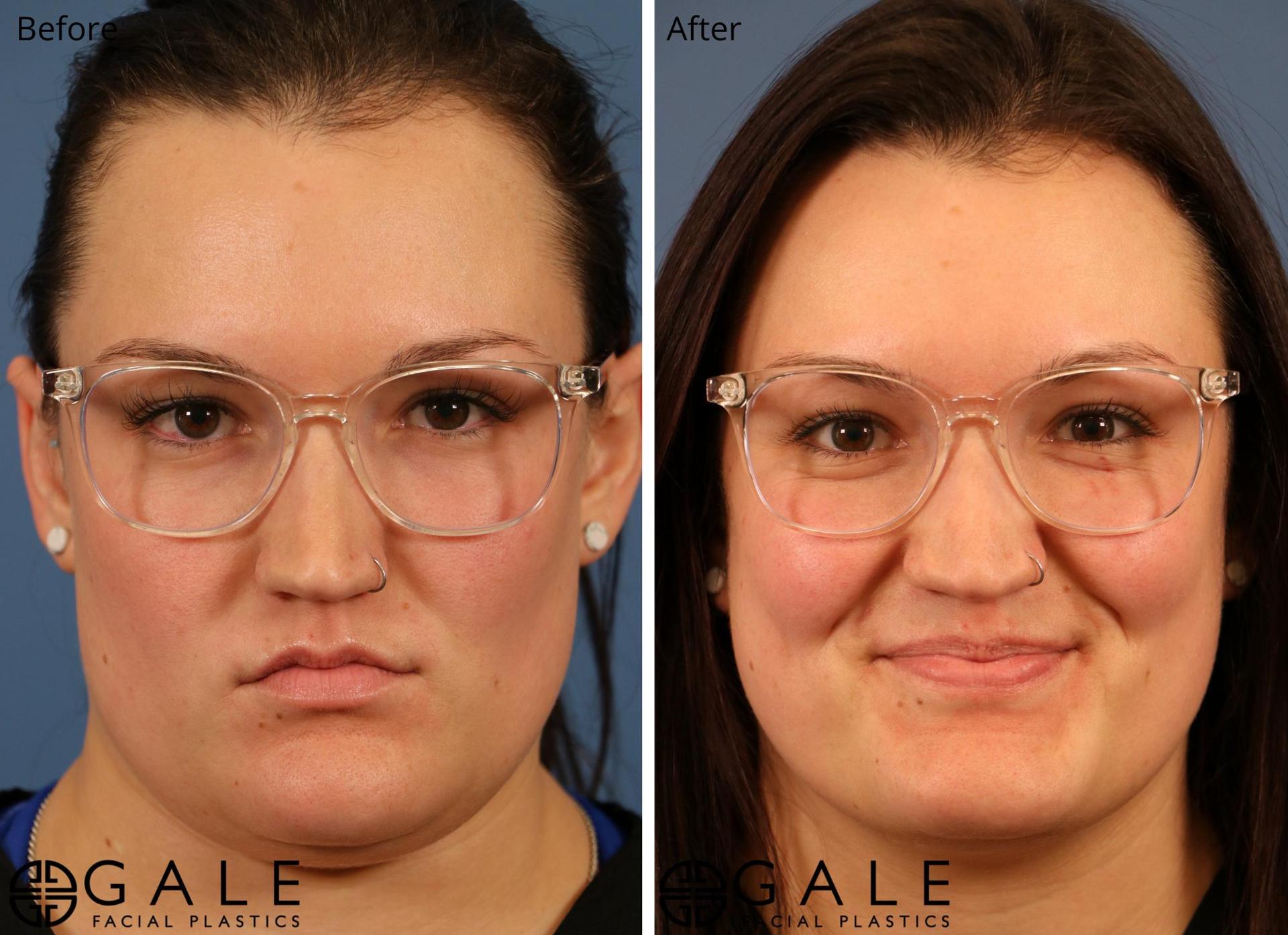 Gale Facial Plastics liposuction result — Riverton, UT