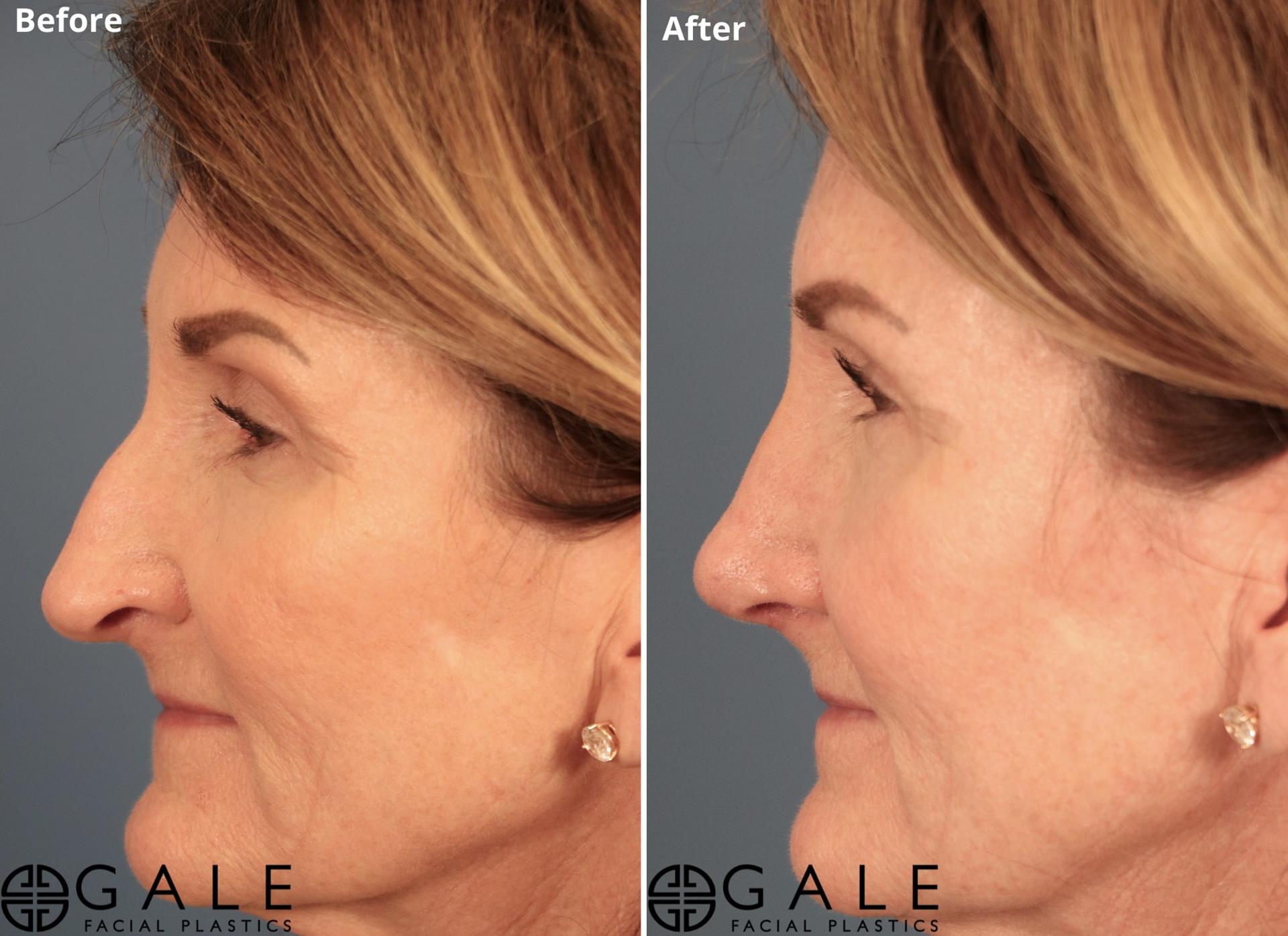 Gale Facial Plastics rhinoplasty result — Riverton, UT