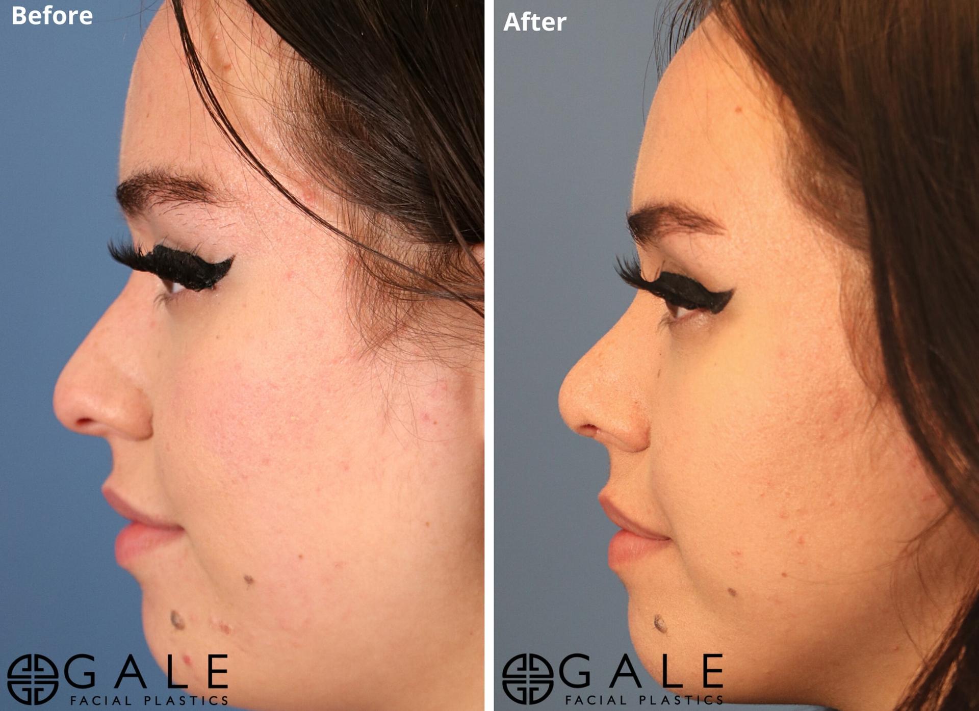 Gale Facial Plastics rhinoplasty result — Riverton, UT