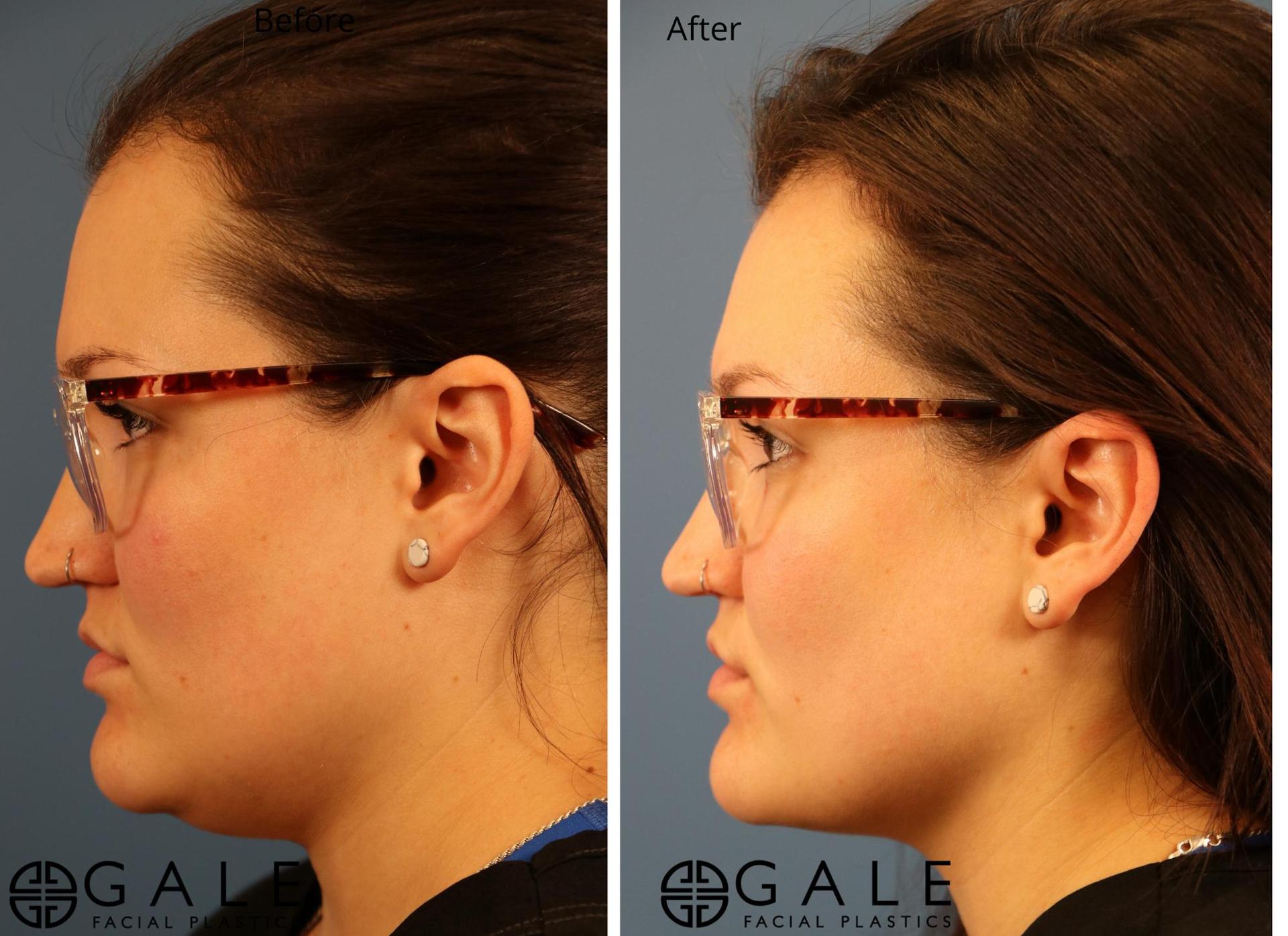 Gale Facial Plastics liposuction result — Riverton, UT